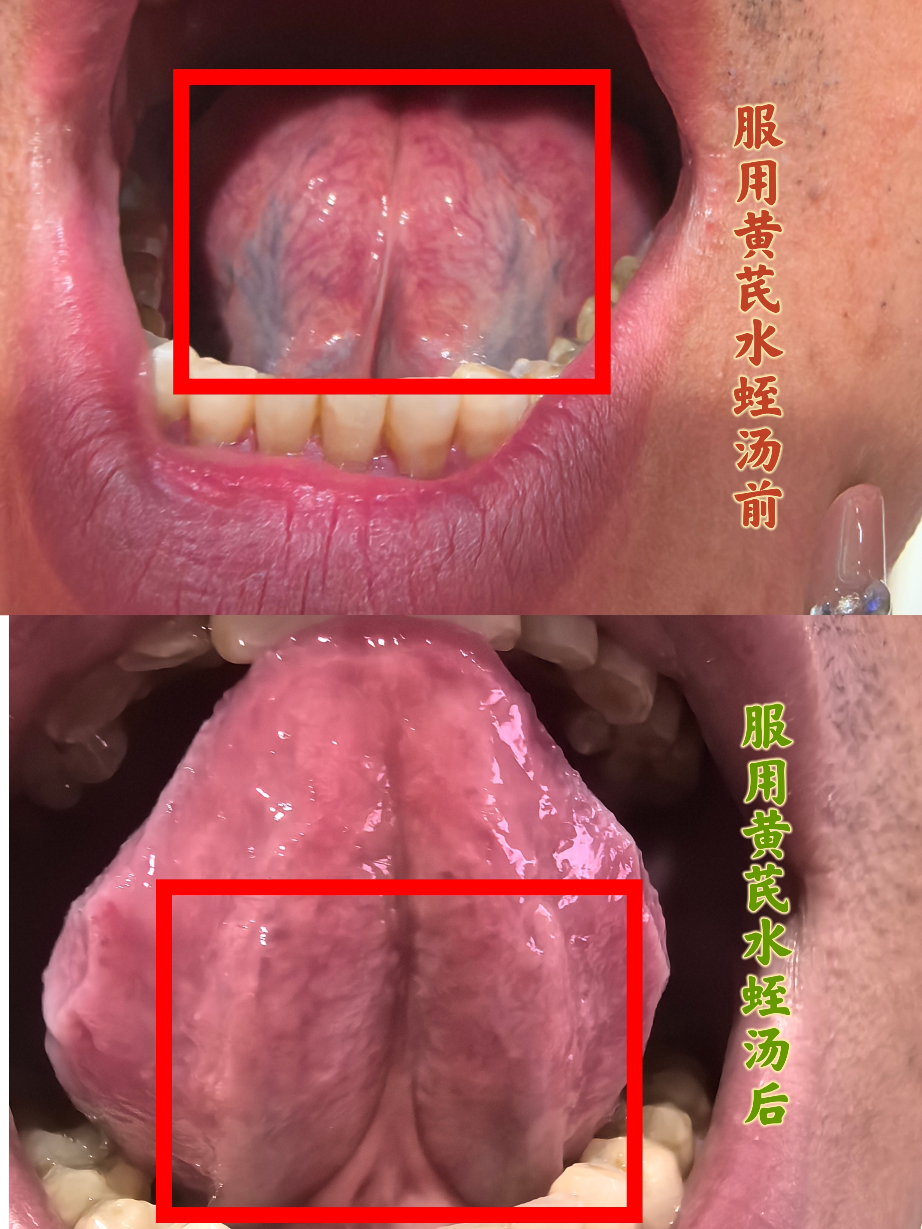 黄芪水蛭汤