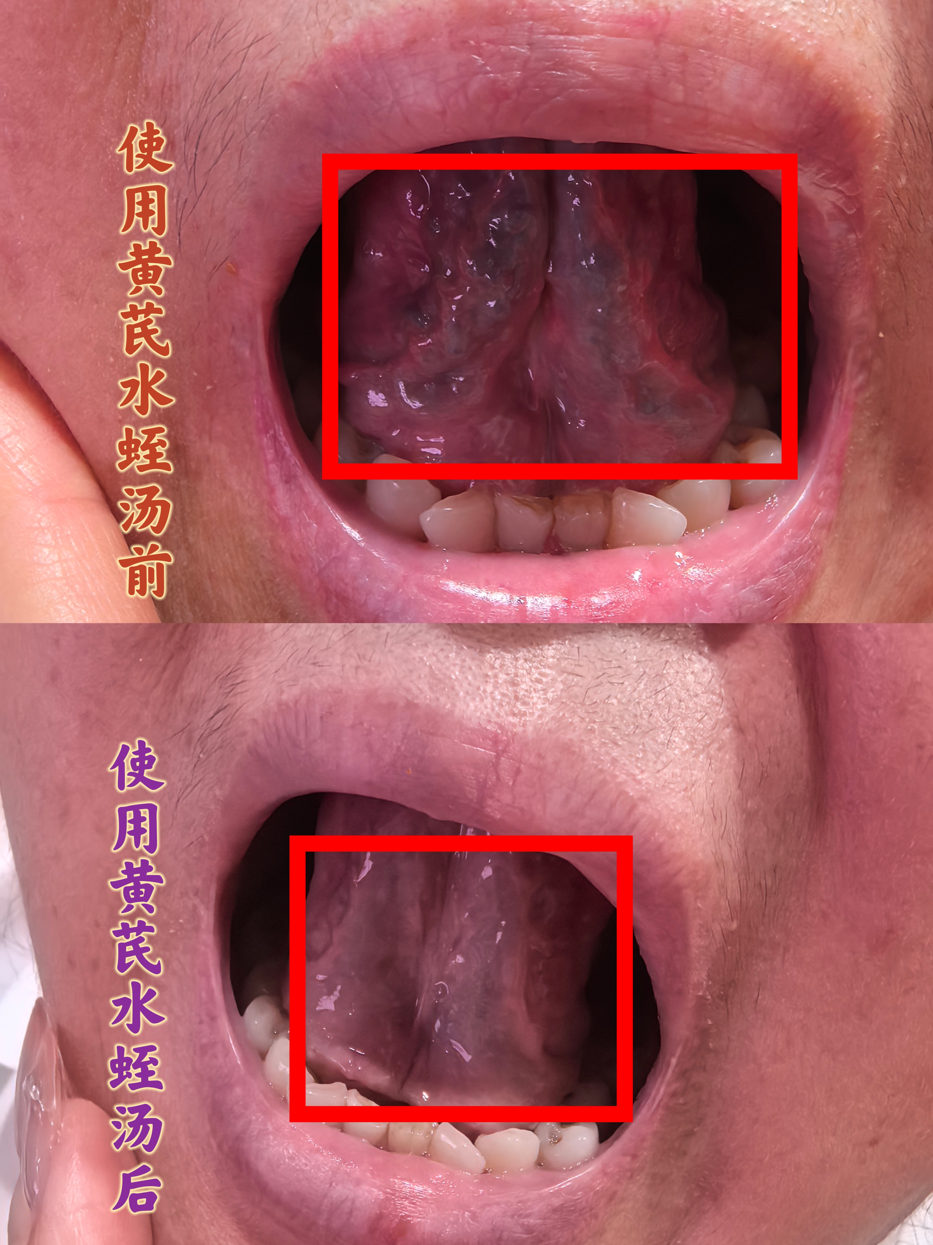黄芪水蛭汤