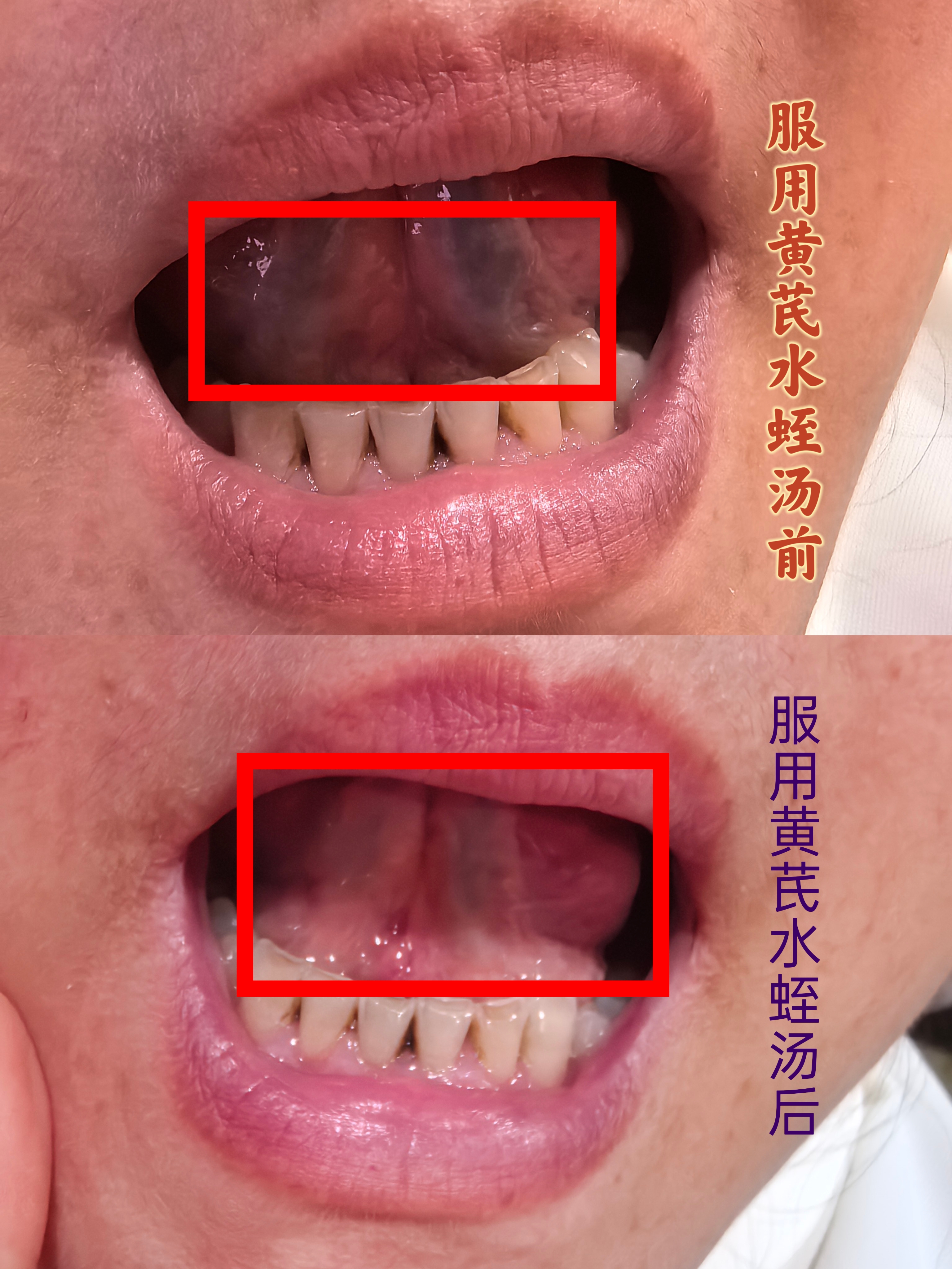 黄芪水蛭汤案例