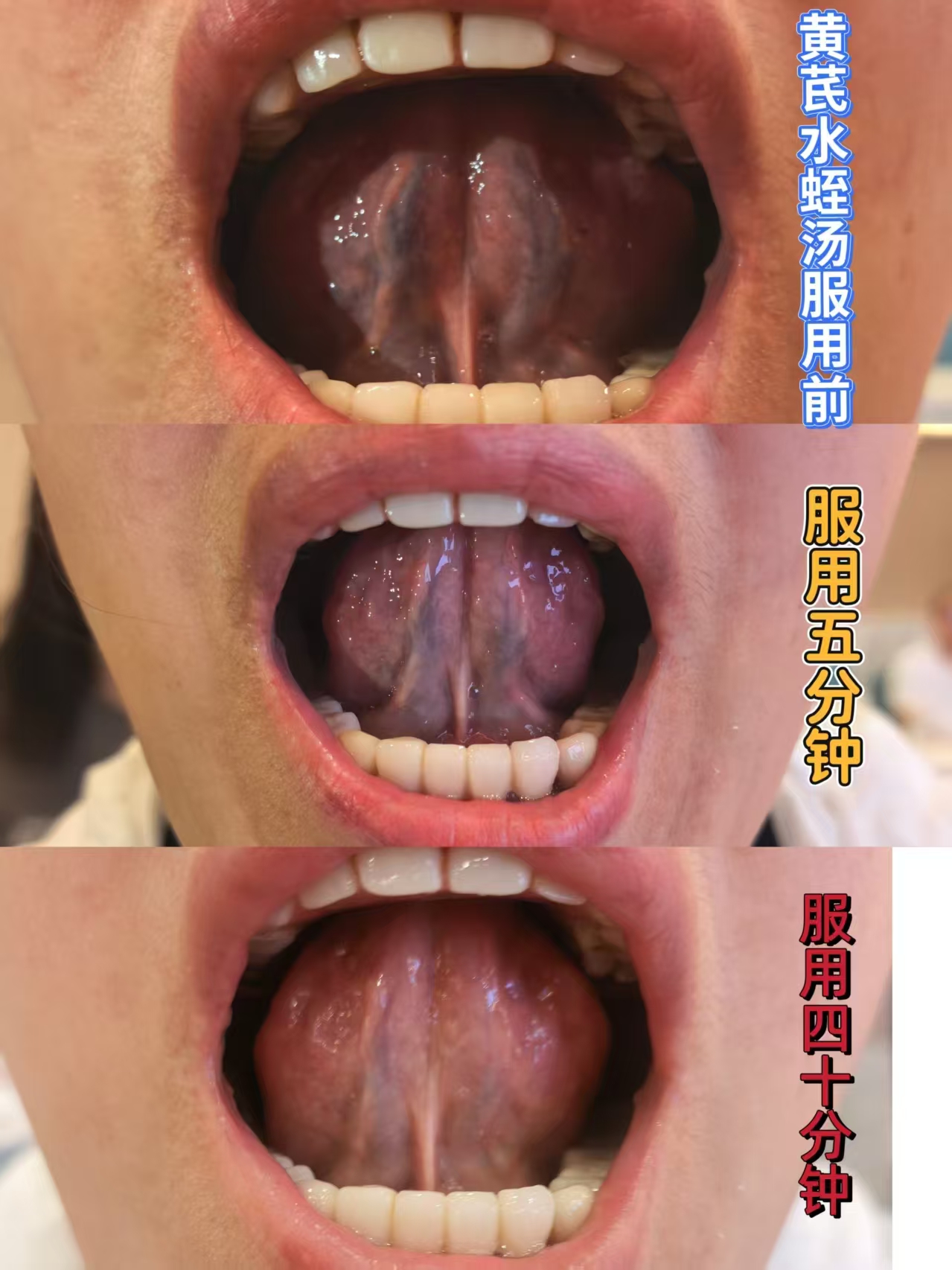 黄芪水蛭汤案例