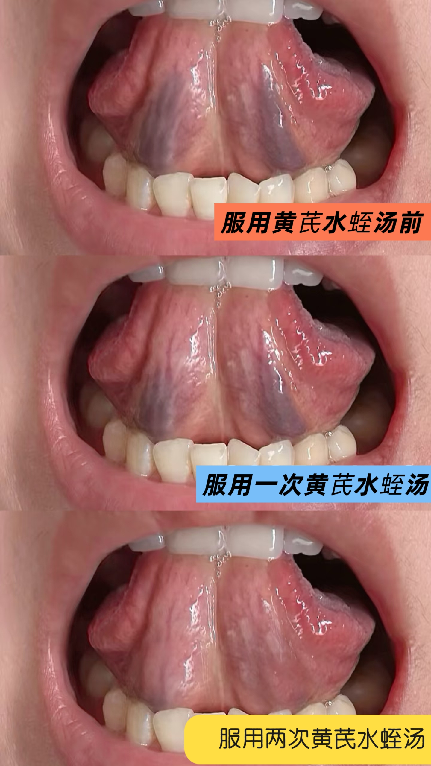 芮立堂黄芪水蛭汤案例