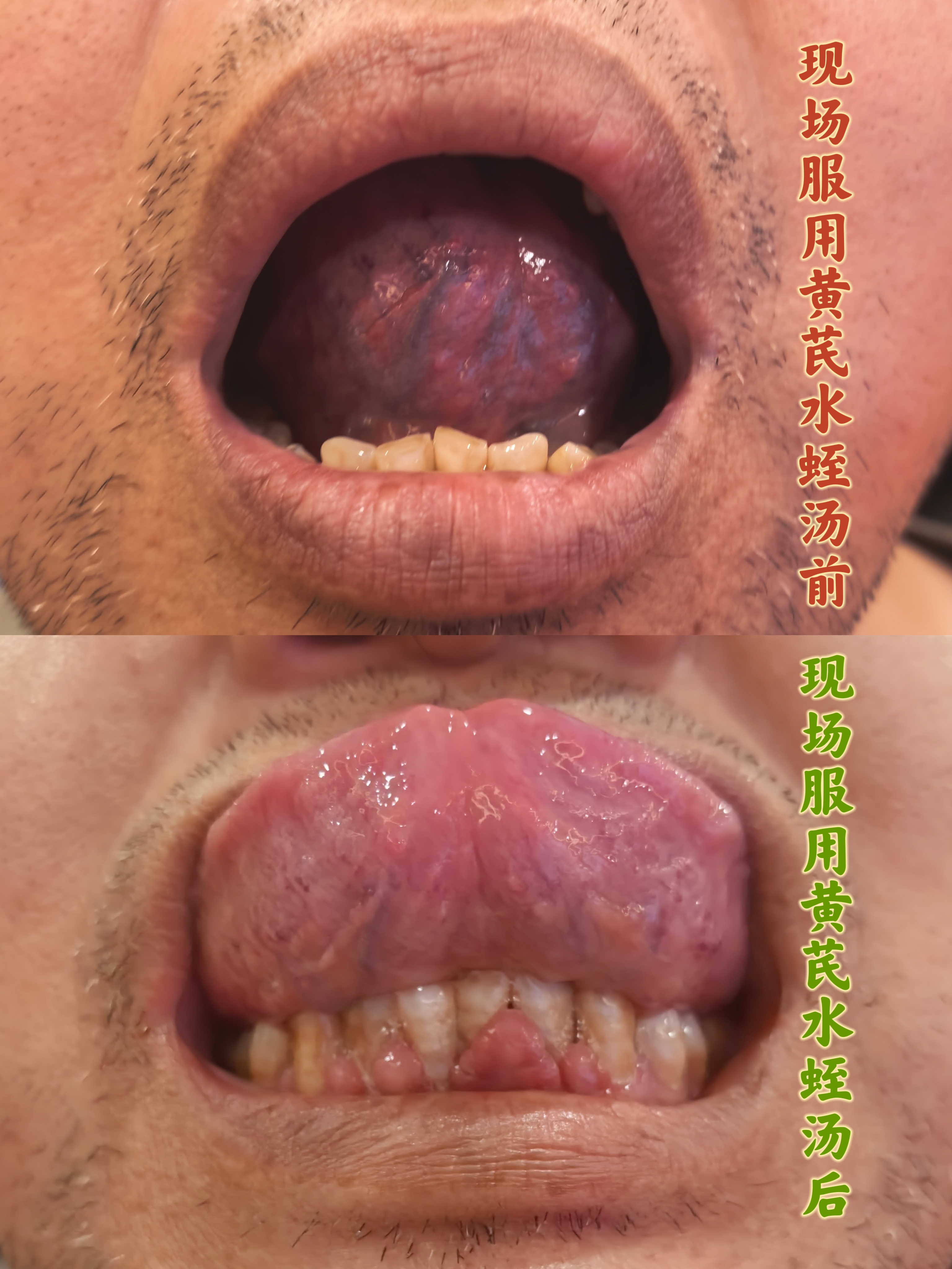 黄芪水蛭汤