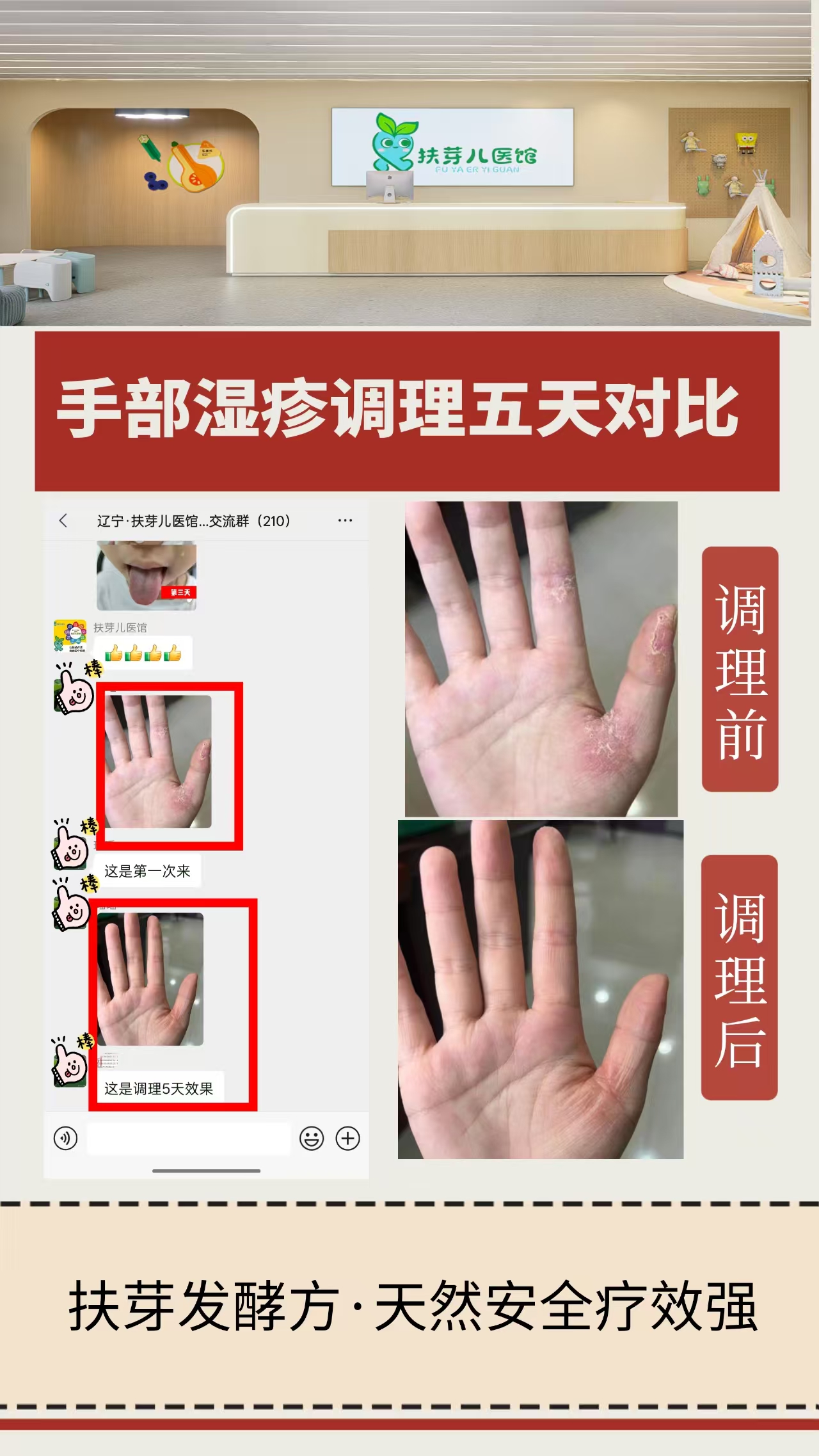 发酵方案例-湿疹