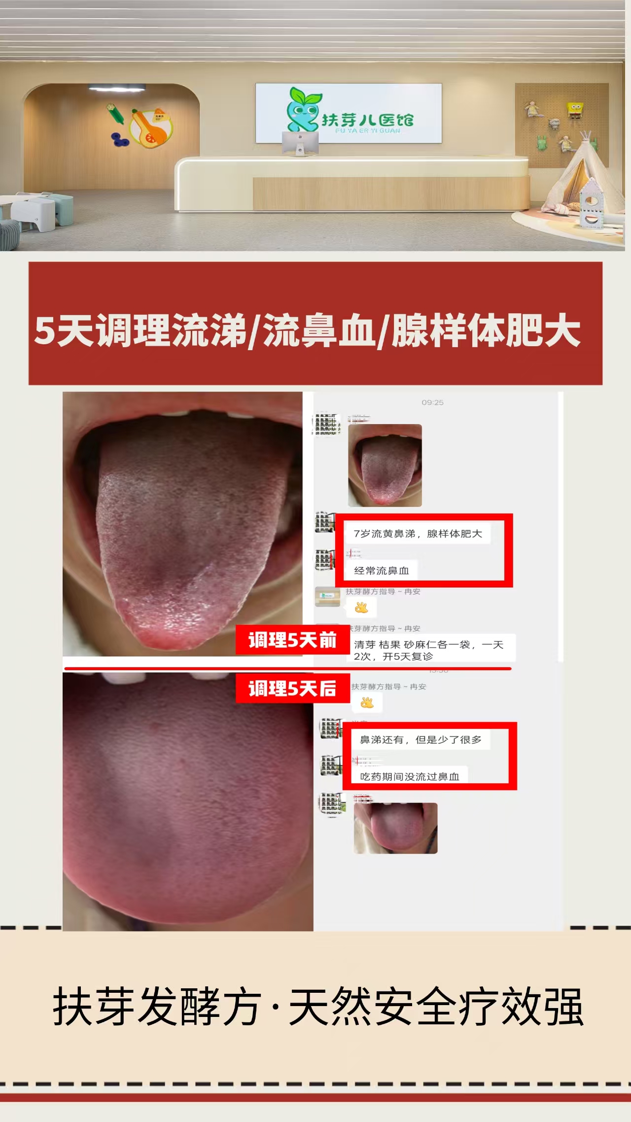 发酵方案例分享｜腺样体肥大、流黄鼻涕、反复流鼻血