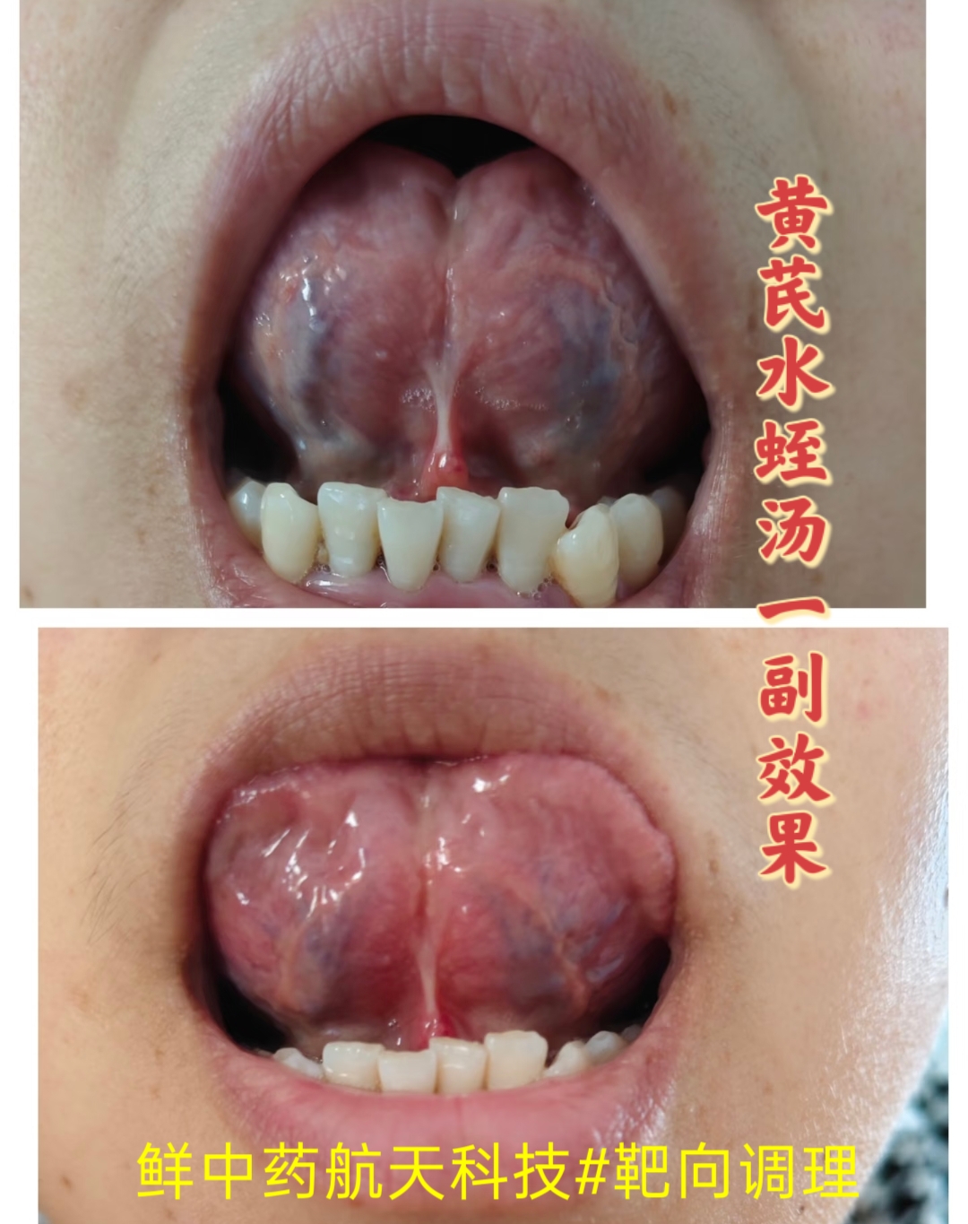 黄芪水蛭汤｜舌下瘀络、血瘀调理