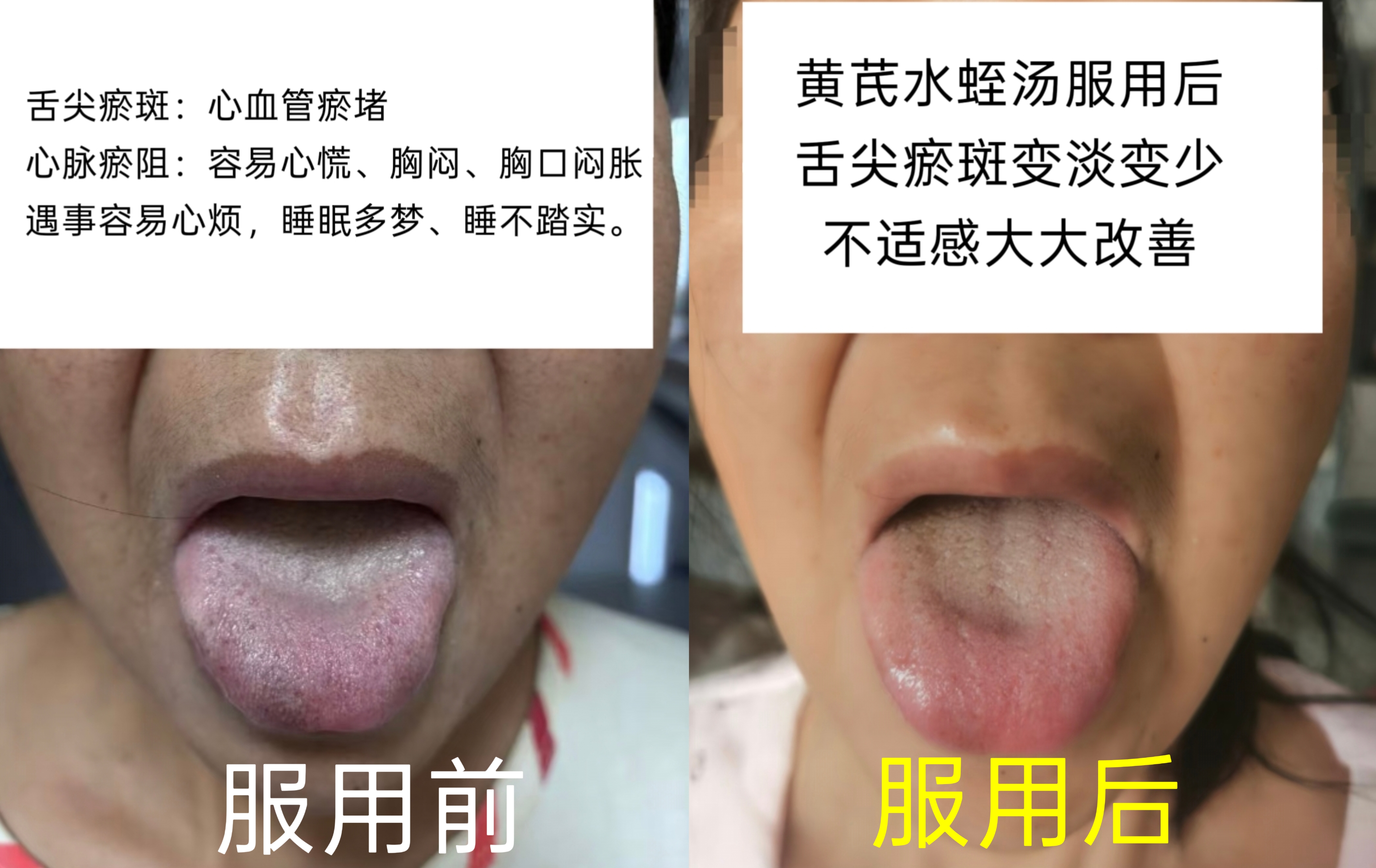 黄芪水蛭汤｜舌尖瘀斑，心血管瘀堵